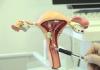 Видалення матки лапароскопічним методом: післяопераційний період, наслідки для організму.